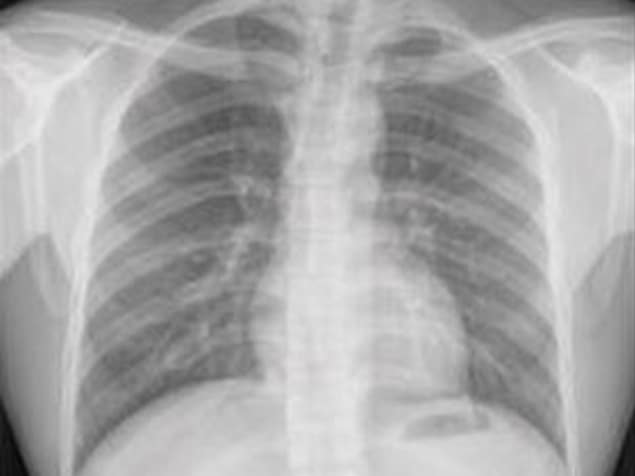 A routine chest X-ray