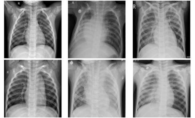 Chest X-ray images