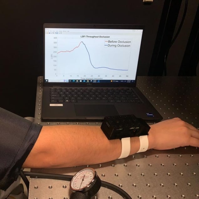 Photo of a new wearable imaging device that monitors changes in blood flow in a patient’s hands, feet or arms. The device is strapped to a person's wrist and the person is looking at a graph on a laptop screen