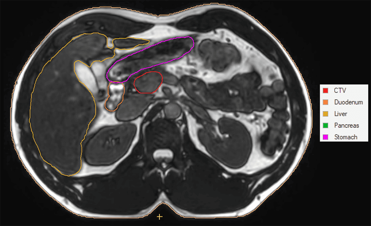 Breath-hold scan image for the pancreas 