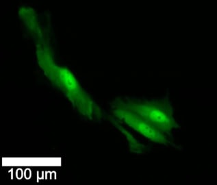 Imágenes de fluorescencia de células cancerosas del cerebro.
